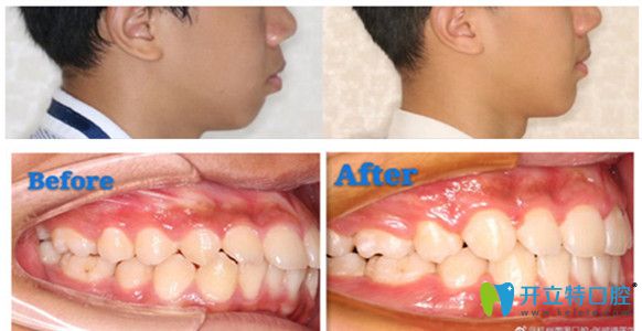 齙牙矯正效果圖