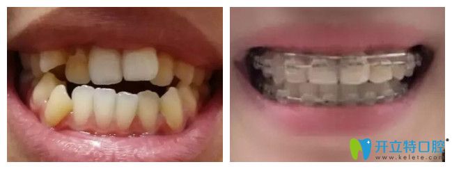 重慶團圓口腔張亞醫(yī)生陶瓷托槽矯正案例