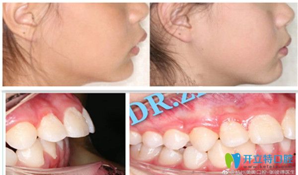 安氏2類1分類矯正變化圖
