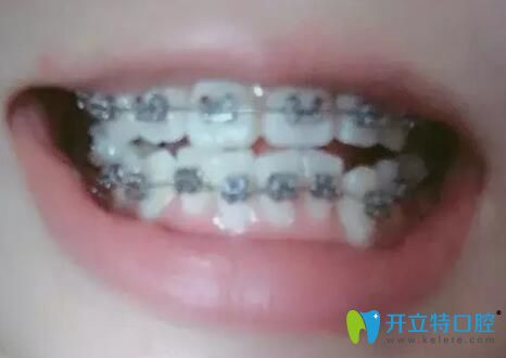 我的齙牙在團(tuán)圓口腔做金屬矯正第3個(gè)月