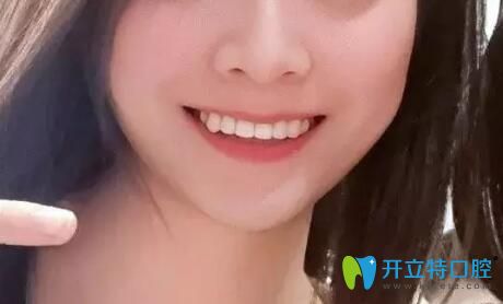 鄭州德正口腔齙牙矯正后效果突
