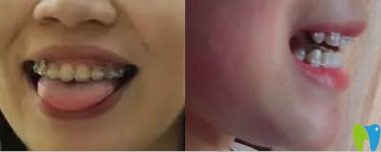 廣州壹加壹口腔陶瓷托槽矯正術(shù)中照