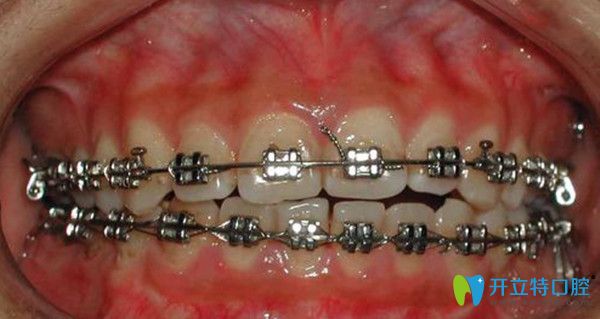 引發(fā)的牙齒開(kāi)合的因素