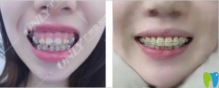 廣州壹加壹口腔做露齦笑矯正前后對(duì)比圖