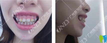 解決露齦笑尷尬，我選擇廣州壹加壹口腔做矯正