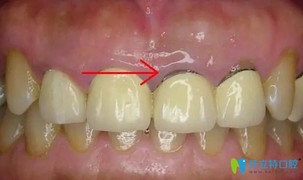 烤瓷牙牙齦黑線(xiàn)