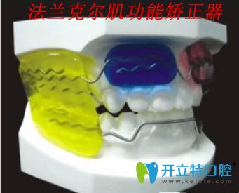 法蘭克爾肌功能矯正器示意圖