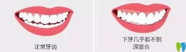 解答:上牙包住下牙多少正常？