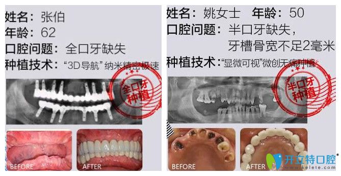 南昌德韓口腔張寧種植牙案例公布 南昌德韓口腔張寧種植牙案例公布
