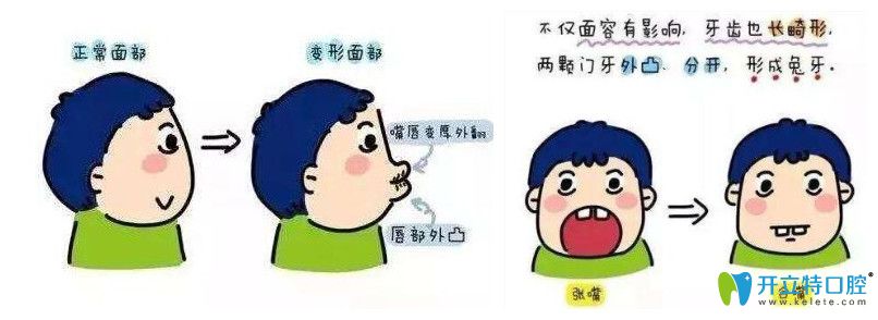 牙為什么越來越往外突，我該如何防止牙越來越外突