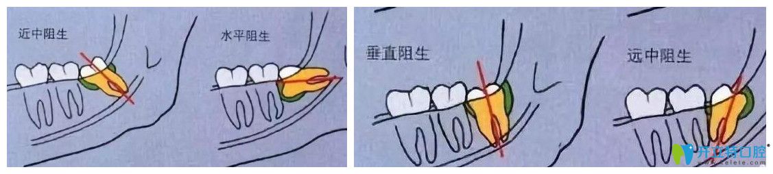 牙齒越來越往外突出原因