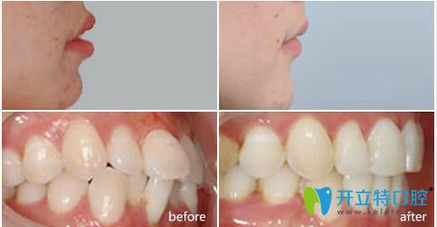 衡陽美萊牙齒矯正效果前后對比圖
