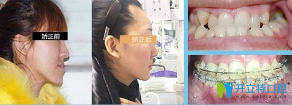 東莞好佰年成人地包天矯正案例及臉型變化對比圖