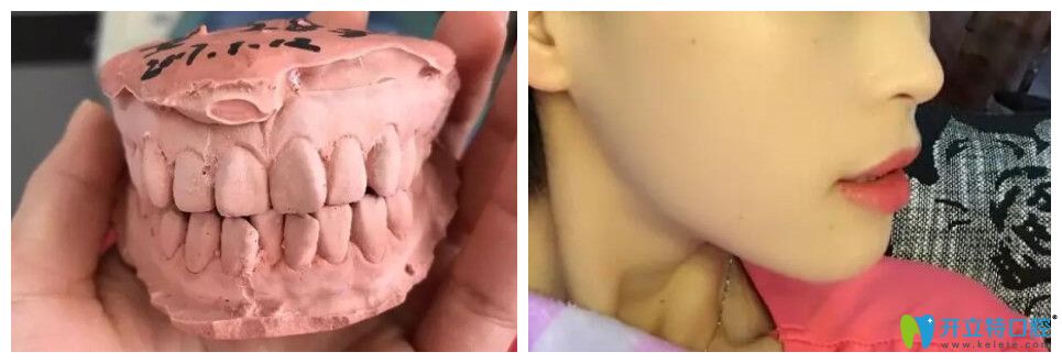 這不僅有上牙外翻圖片，還有上牙外翻矯正的方法及價(jià)格