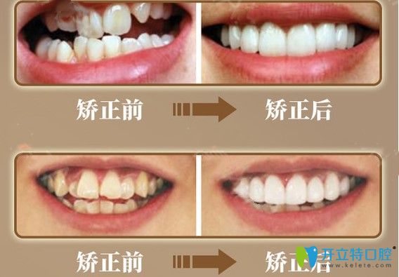 成都圣貝牙齒擁擠和地包天矯正案例效果
