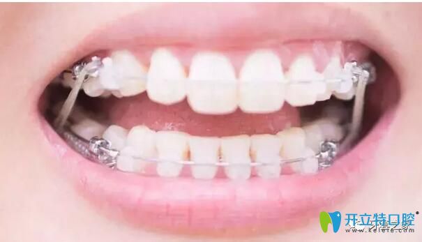 牙齒正畸過程開始關(guān)閉牙齒縫隙