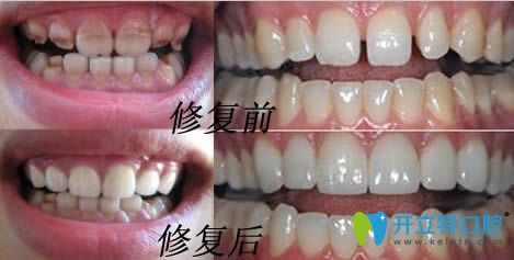 衡陽美萊生態(tài)美牙冠修復(fù)效果前后對比圖