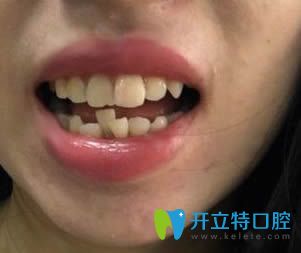 牙齒不齊,我選擇在樂山英美口腔做二氧化鋯全瓷牙來修復