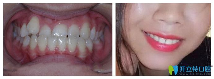 沈陽康貝佳口腔隱形牙齒矯正效果