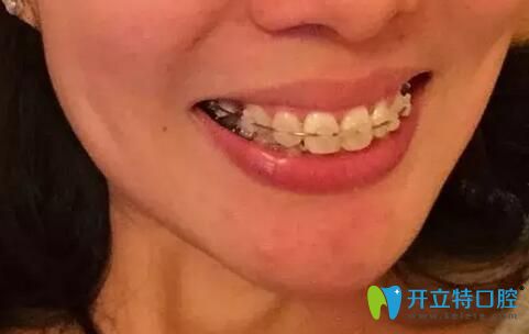 拆掉墊高的樹脂后，發(fā)現(xiàn)咬合全錯位了