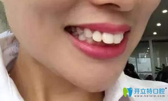 矯正前，上排門牙外凸