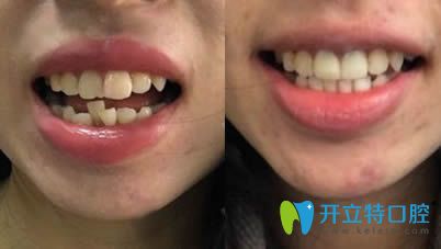樂山英美口腔做二氧化鋯全瓷牙前后對比效果圖 樂山英美口腔做二氧化鋯全瓷牙前后對比效果圖