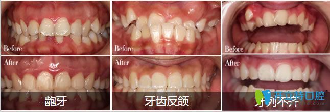 成人齙牙矯正和青少年地包天矯正等圖