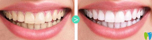 瓷貼面效果圖 瓷貼面效果圖