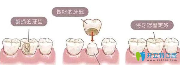 牙冠修復(fù)的意義及圖解