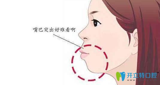 如何快速矯正凸嘴?改善嘴凸下巴縮有自然方法也有物理方法