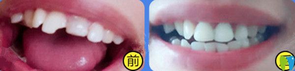 全瓷牙前后對(duì)比圖 全瓷牙前后對(duì)比圖