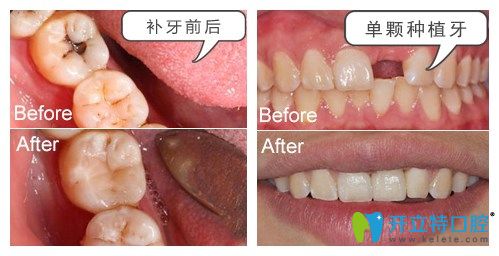 湛江致美口腔種植牙補(bǔ)牙案例 湛江致美口腔種植牙補(bǔ)牙案例