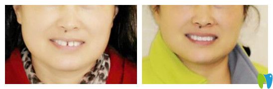 南昌輝煌口腔牙縫大矯正療效