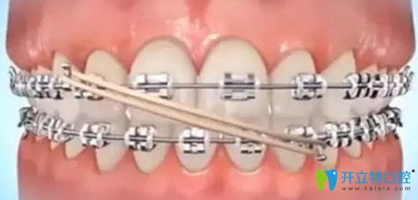 矯正中哪個(gè)階段需要佩戴橡皮圈
