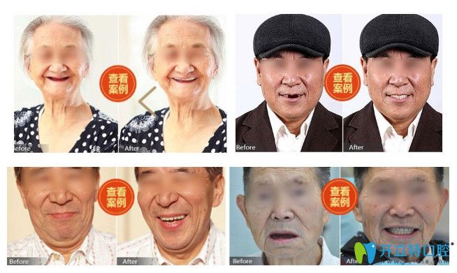 長(zhǎng)沙中諾口腔全口和半口種植牙案例圖 長(zhǎng)沙中諾口腔全口和半口種植牙案例圖