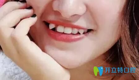 在濟(jì)南品潔口腔矯正虎牙83天，曬我的虎牙戴牙套變化圖