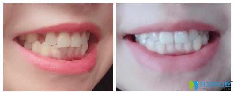 南昌安植雅口腔單顆種植牙實(shí)例