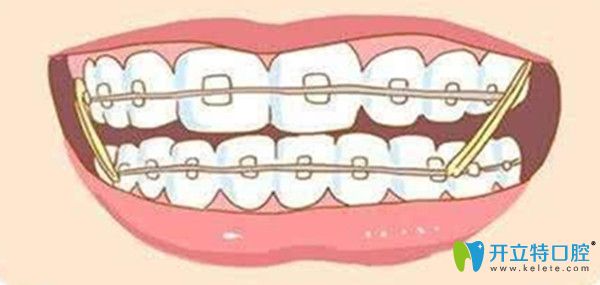 想了解牙齒矯正中橡皮筋的作用/掛多久等等，這里都有哦