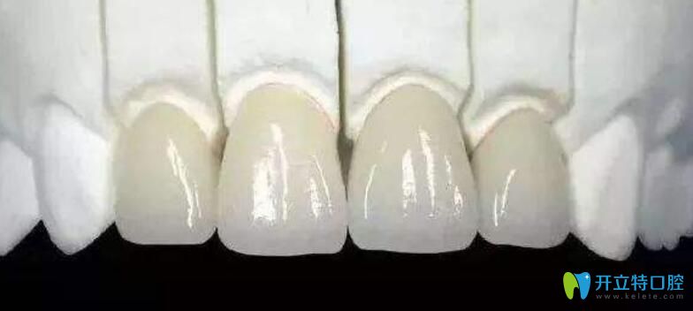 門牙做了烤瓷牙還能矯正嗎？聽濟(jì)南品潔口腔醫(yī)生解析