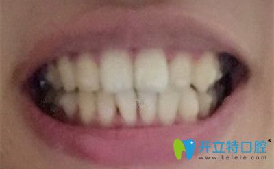 戴隱形牙套6個月的效果