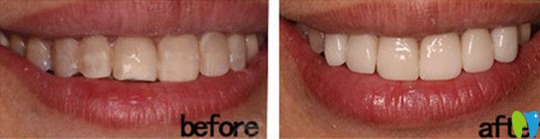 牙齒美白修復(fù)前后效果圖