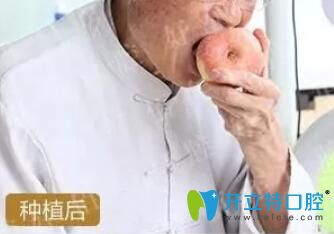 80歲老人全口種植親身經(jīng)歷