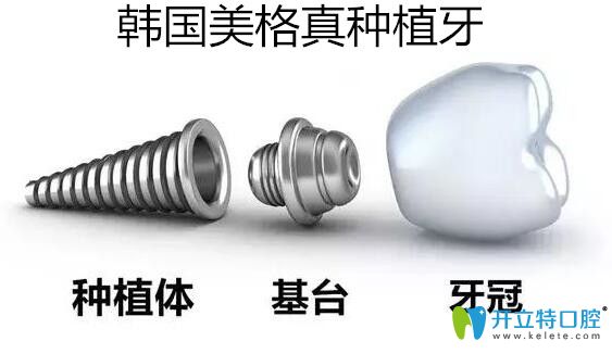 韓國美格真種植牙