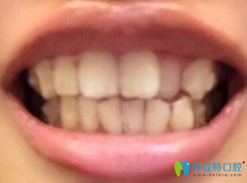 剛開始戴第1副隱適美牙套