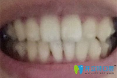 隱形牙套前后效果圖片