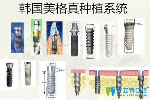 韓國美格真種植系統(tǒng)
