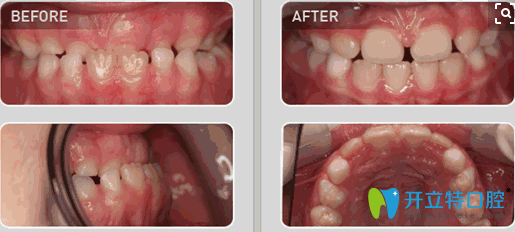 王涪華兒童地包天早期矯正前后對(duì)比效果圖 王涪華兒童地包天早期矯正前后對(duì)比效果圖