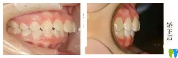 長(zhǎng)沙中諾口腔丁建宇深覆蓋牙齒矯正案例 長(zhǎng)沙中諾口腔丁建宇深覆蓋牙齒矯正案例