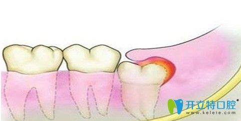 滕艷醫(yī)生解析智齒一定要拔嗎 滕艷醫(yī)生解析智齒一定要拔嗎