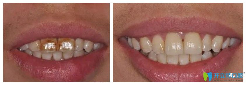 牙齒仿生美學(xué)修復(fù)前后對比效果圖